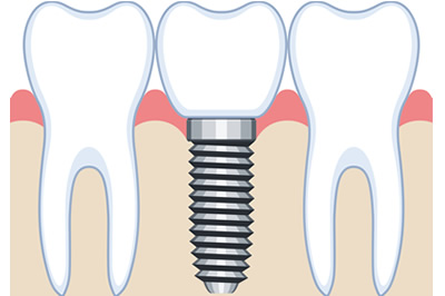 インプラントのイメージ